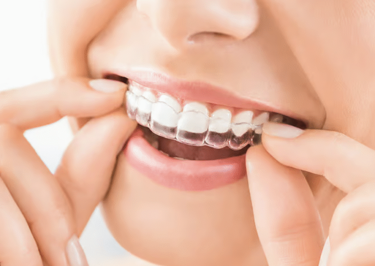 Patient wearing Invisalign clear aligners in Grayson dental office